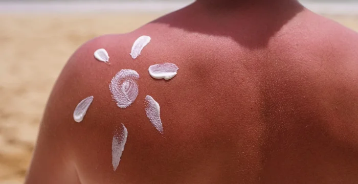 Eritema Solare