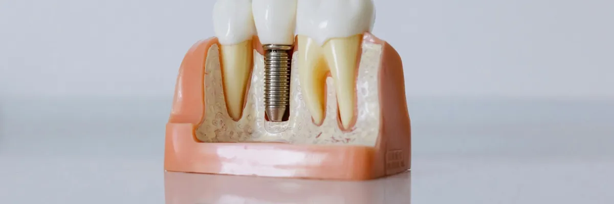 Quando devi andare dal dentista? Ecco gli interventi più comuni